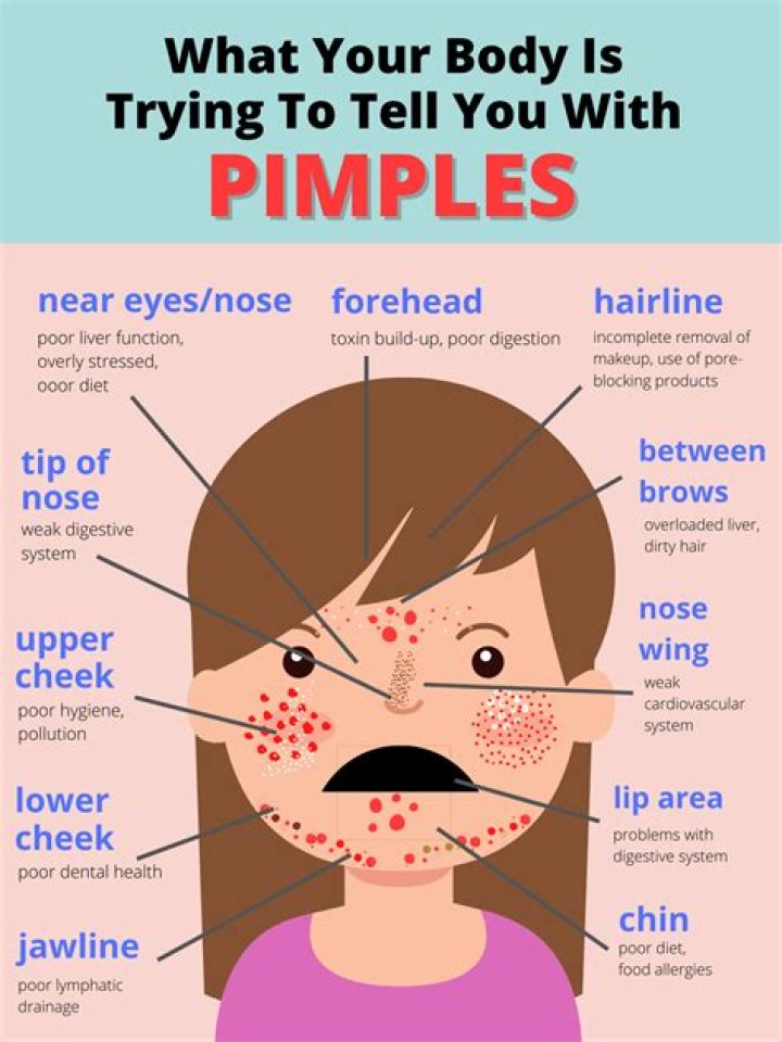 Why am I getting new pimples everyday?