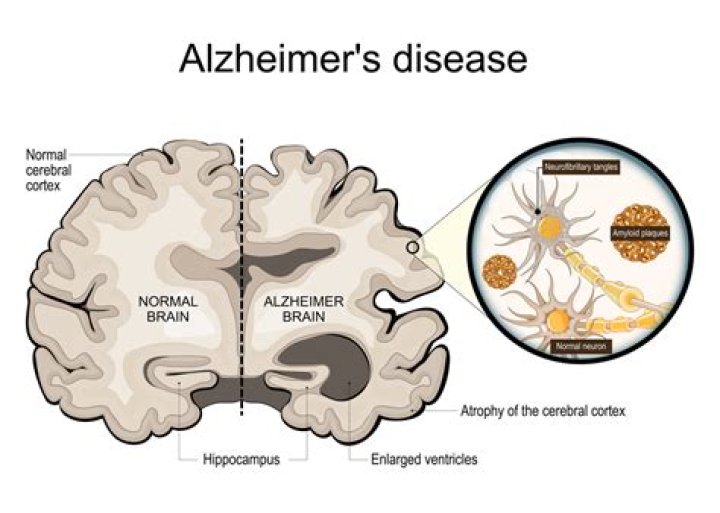 Why do Alzheimer's patients talk so much?