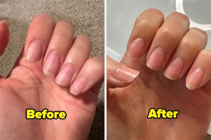 Why do my nails hurt after taking off nail polish?