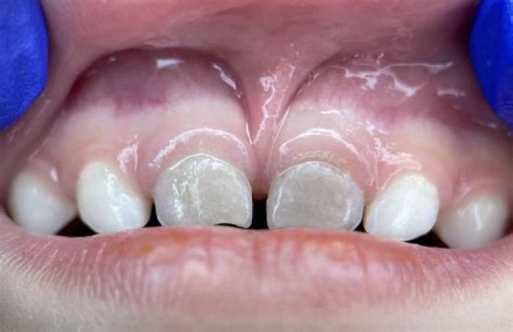 Why is my child's baby tooth black?