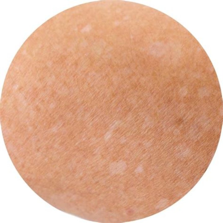 Why won't my spots go away?