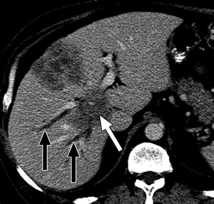Will a CT scan show blocked bile ducts?